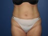 Liposuction