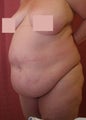 liposuction of abdomen and flanks