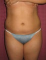 liposuction of abdomen and flanks