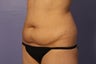 Liposuction