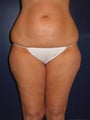 Liposuction
