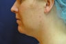 Liposuction