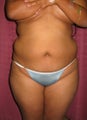 Liposuction