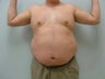 59 year old male liposuction