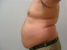 59 year old male liposuction