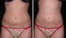 Liposuction