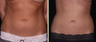 Liposuction