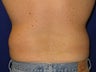 Liposuction