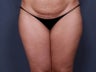 Liposuction