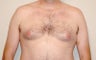 Before and After Gynecomastia Treatment With Liposuction