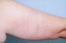 Upper Arm Liposuction