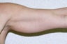Upper Arm Liposuction