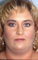 Liposuction Neck