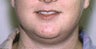 Neck Liposuction