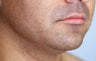 Neck Liposuction