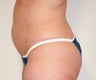 Power Assisted Liposuction