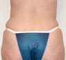 Power Assisted Liposuction