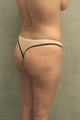 Buttock augmentation and liposculpture