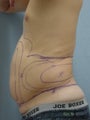 Liposuction