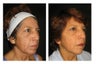 Non-Surgicial Facelift