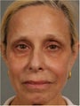 60 Year Old Female treated for under eye puffiness, sagging cheeks and frown lines non surgically
