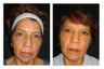Non-Surgicial Facelift