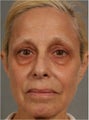 60 Year Old Female treated for under eye puffiness, sagging cheeks and frown lines non surgically