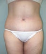 Before and After Lower Body Lift