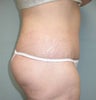 Before and After Lower Body Lift