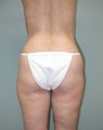 Lower Body Lift