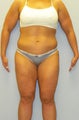 Lower Body Lift