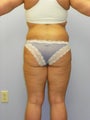 Lower Body Lift