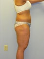 Lower Body Lift