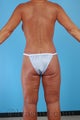 Lower Body Lift, Inner Thigh Lift