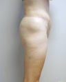 Before and After Lower Body Lift (Lateral View)