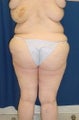 Post bariatric surgery lower body lift
