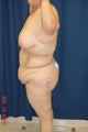 Bodylift post bariatric surgery