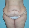 Before and After Lower Body Lift