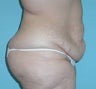 Before and After Lower Body Lift