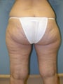 Lower Body Lift