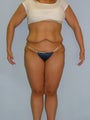 Lower Body Lift