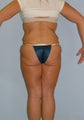 Lower Body Lift