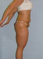 Lower Body Lift