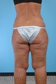 Lower Body Lift, Inner Thigh Lift