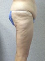 Before and After Lower Body Lift (Lateral View)