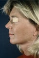 Lower Facelift