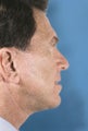 Facelift for Men