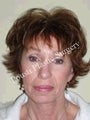 Face Lift, Forehead Lift, Neck Lift