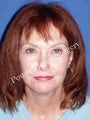 Eyelid Surgery (Blepharoplasty), Face Lift