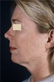Lower Facelift